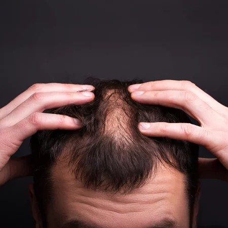 Comment arrêter la chute des cheveux ?