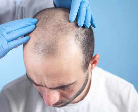 Quand peut-on se laver les cheveux après une greffe de cheveux à Paris ?