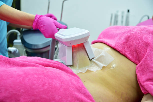 cryolipolyse à Villefranche