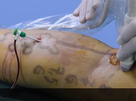 Comment se préparer correctement avant une intervention avec le Laser varices ?