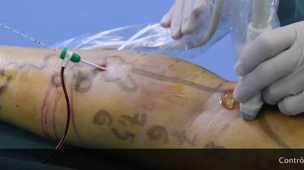 Laser varices